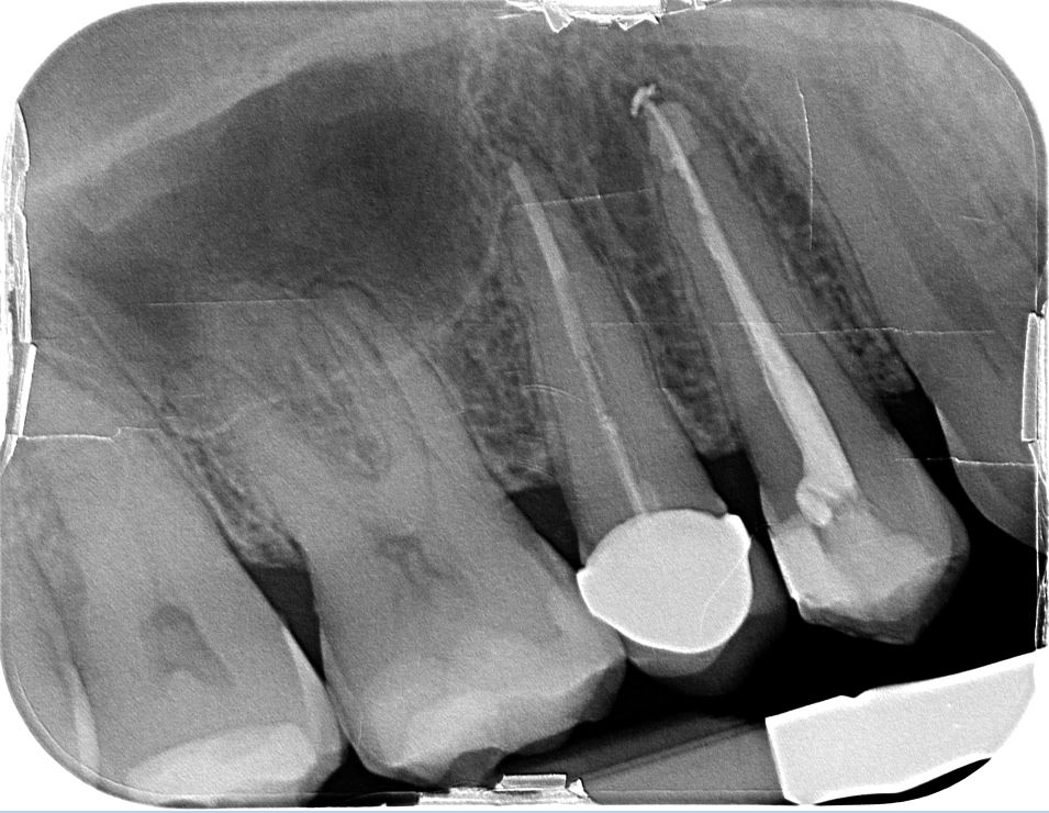 A febbraio 2021 mi Ã¨ stata fatta una cura canalare al dente 14