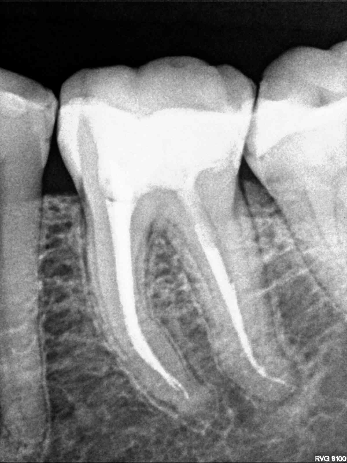 Ho problemi a un dente devitalizzato da 14 mesi