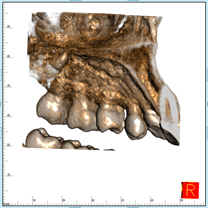 Radice del dente del giudizio lasciata nel seno mascellare: rischi e dubbi
