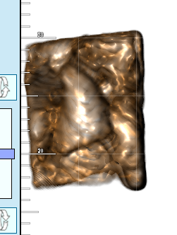 Radice del dente del giudizio lasciata nel seno mascellare: rischi e dubbi