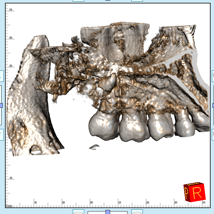 Radice del dente del giudizio lasciata nel seno mascellare: rischi e dubbi