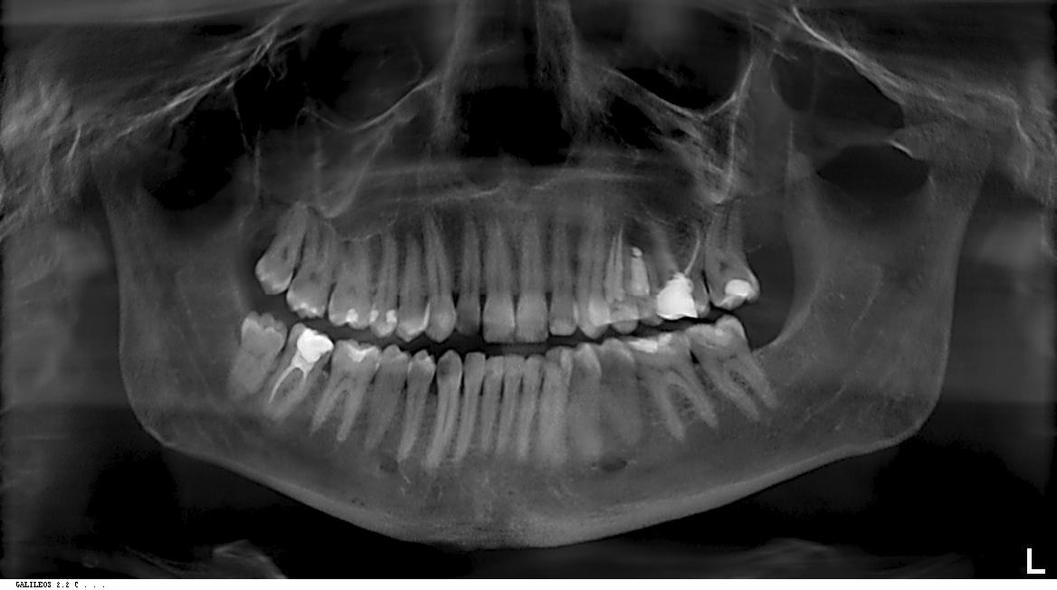 Mi hanno diagnosticato una frattura della radice del 26