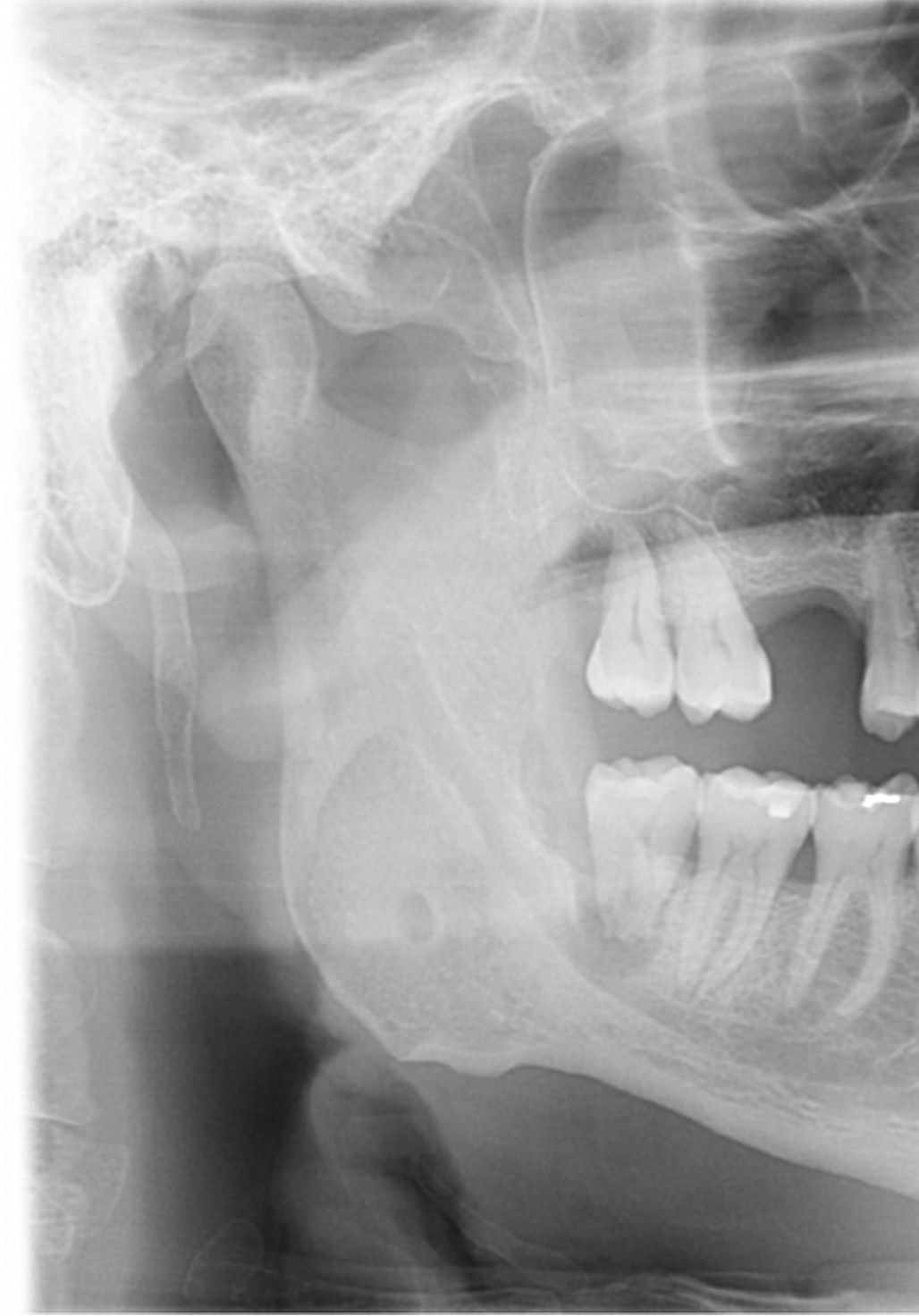 Rarefazione ossea in prossimità del molare 48.