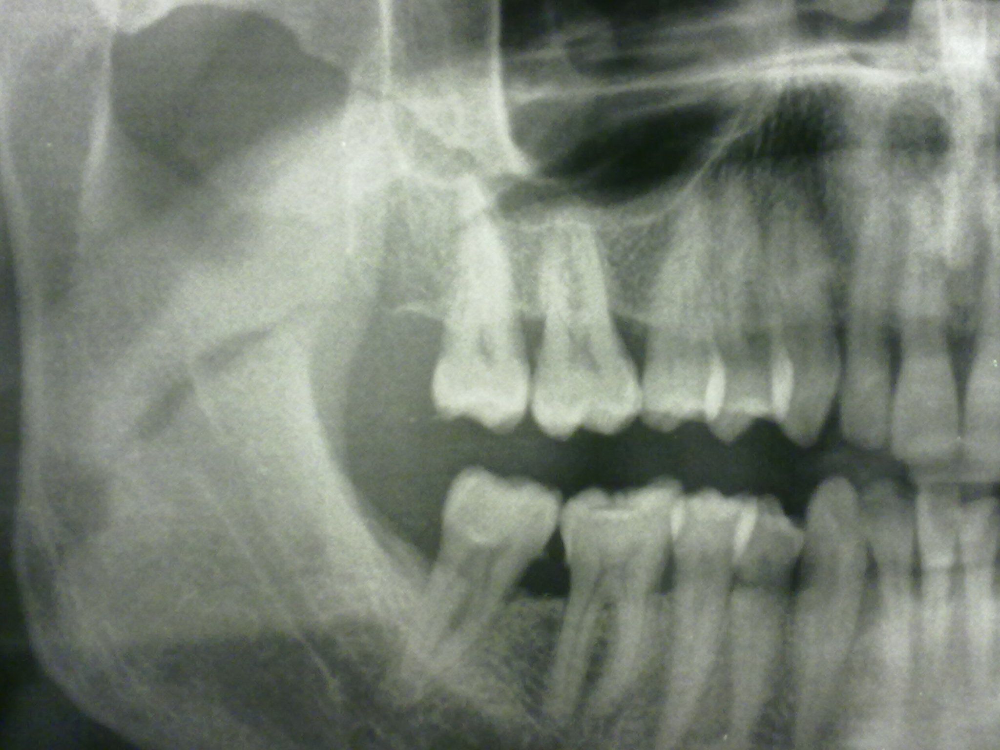 Da circa tre settimane accuso un pressante dolore in prossimità del terzo molare inf. sx.