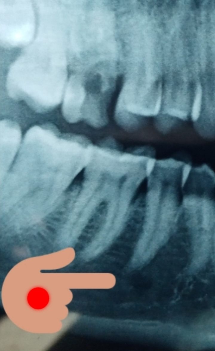 Estrazione molare superiore devitalizzato, rotto e cariato.