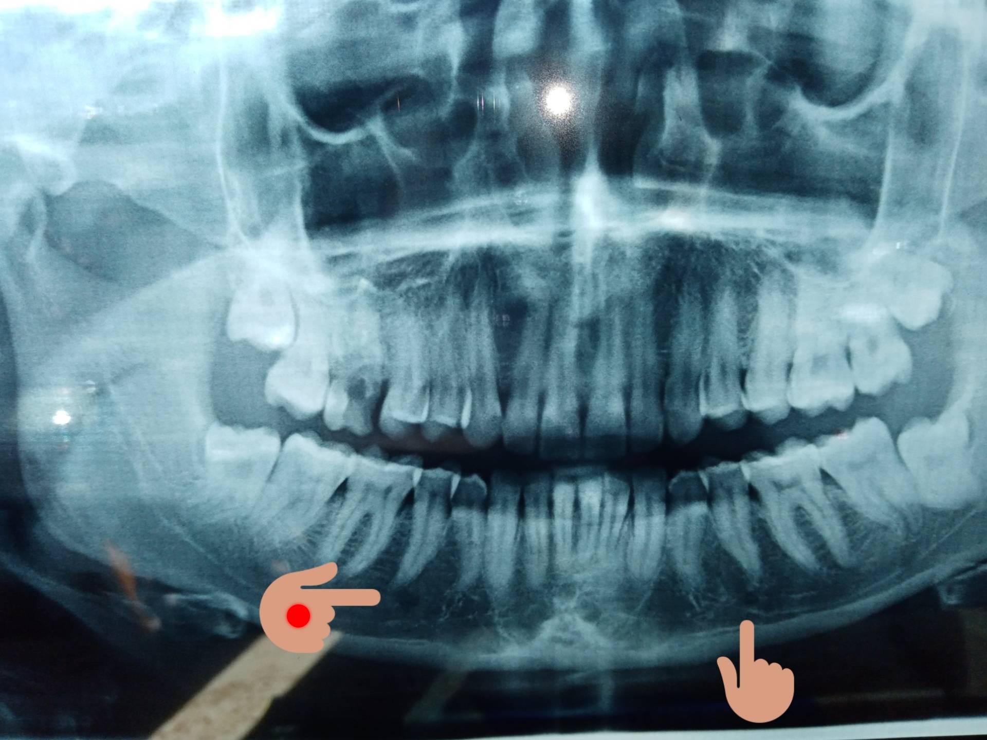 Estrazione molare superiore devitalizzato, rotto e cariato.