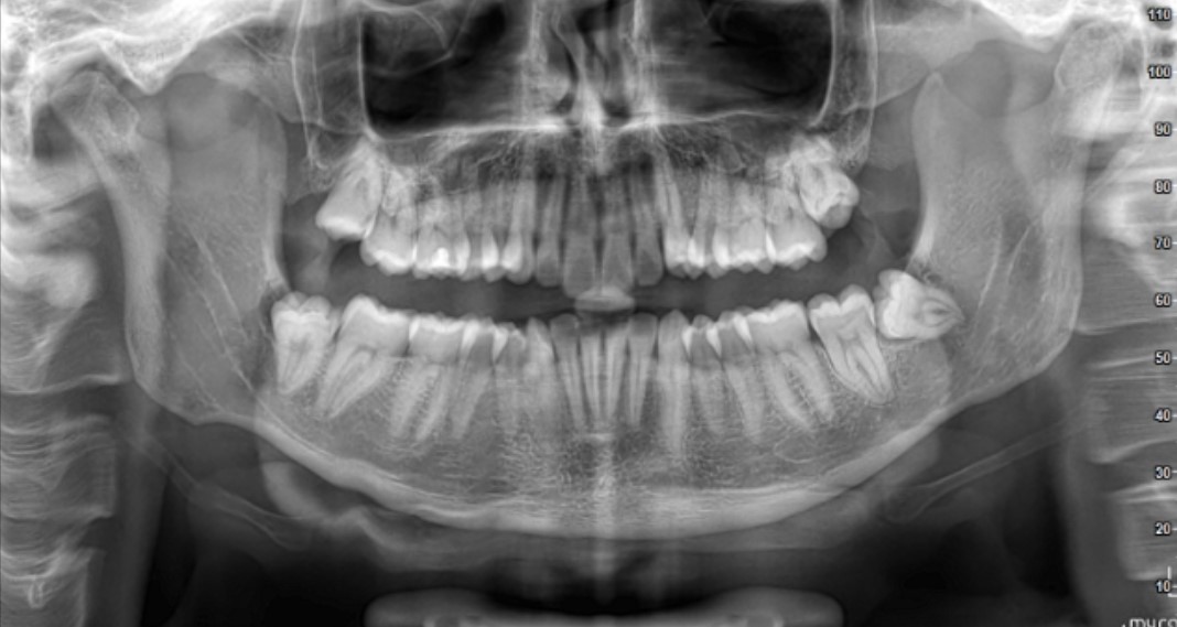 Sono un ragazzo di 21 anni e da circa 5 mesi soffro di mal di denti