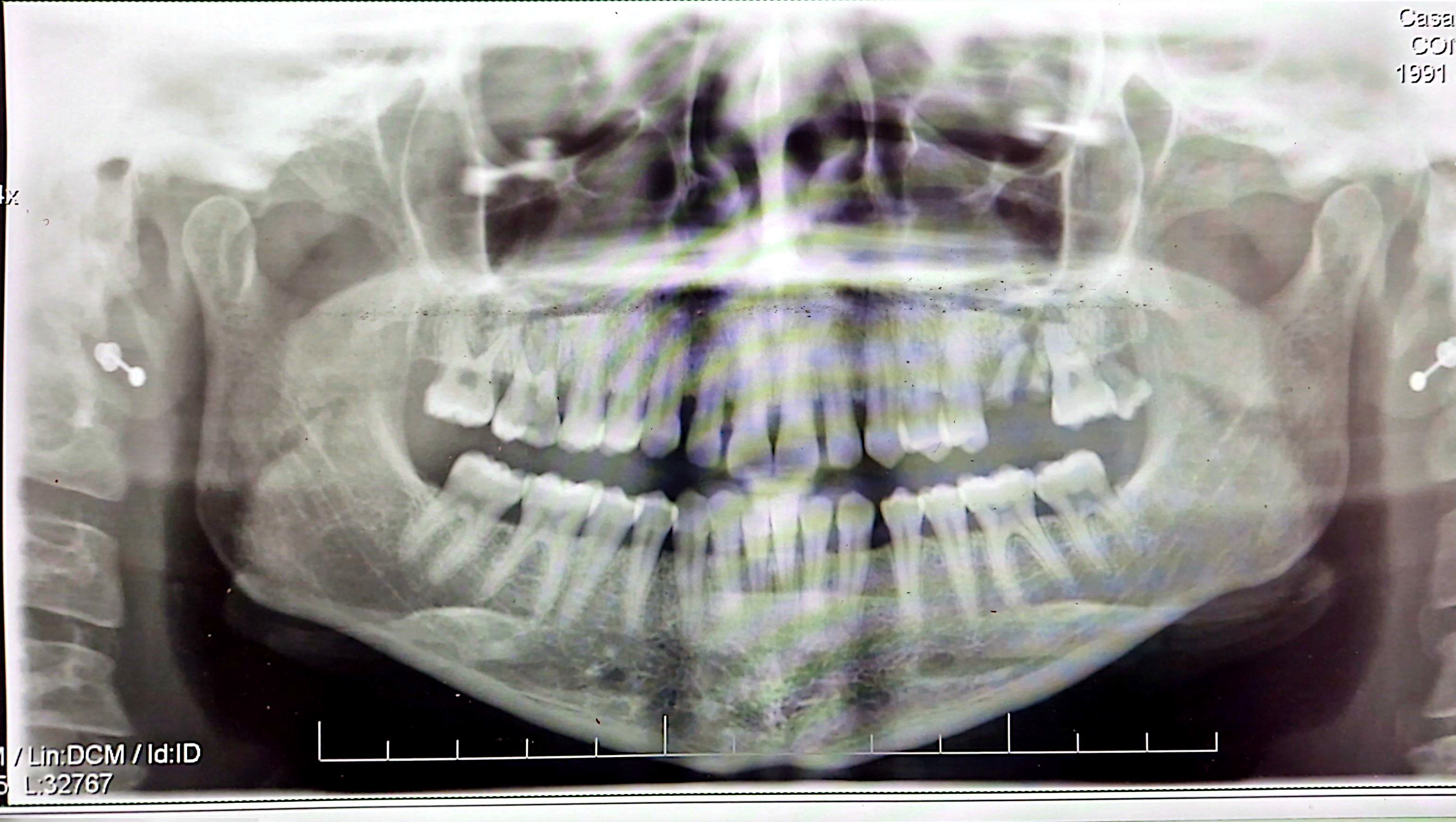 Estrazione di tre denti: è davvero necessaria?