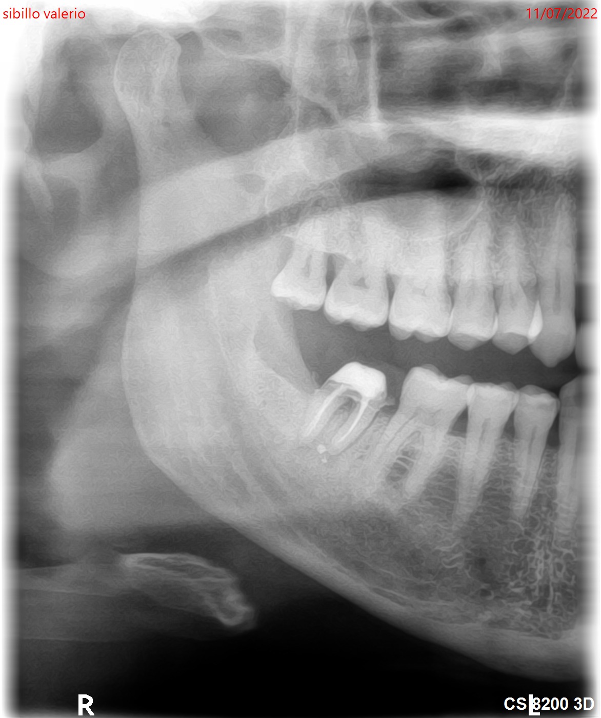 Il dente 47 ha una frattura radicolare?