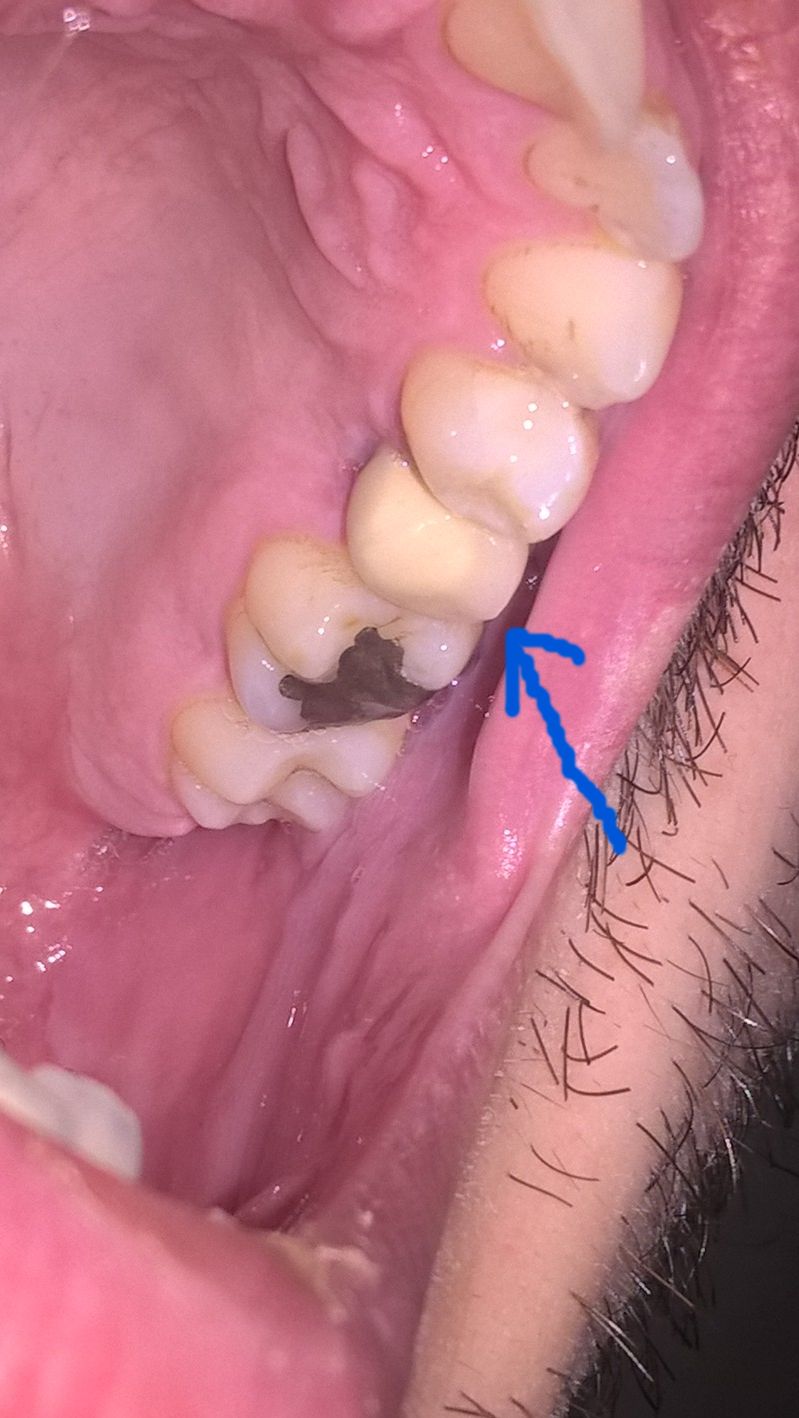 Da circa quattro mesi mi Ã¨ stata messa la prima corona di metallo ceramica su un impianto