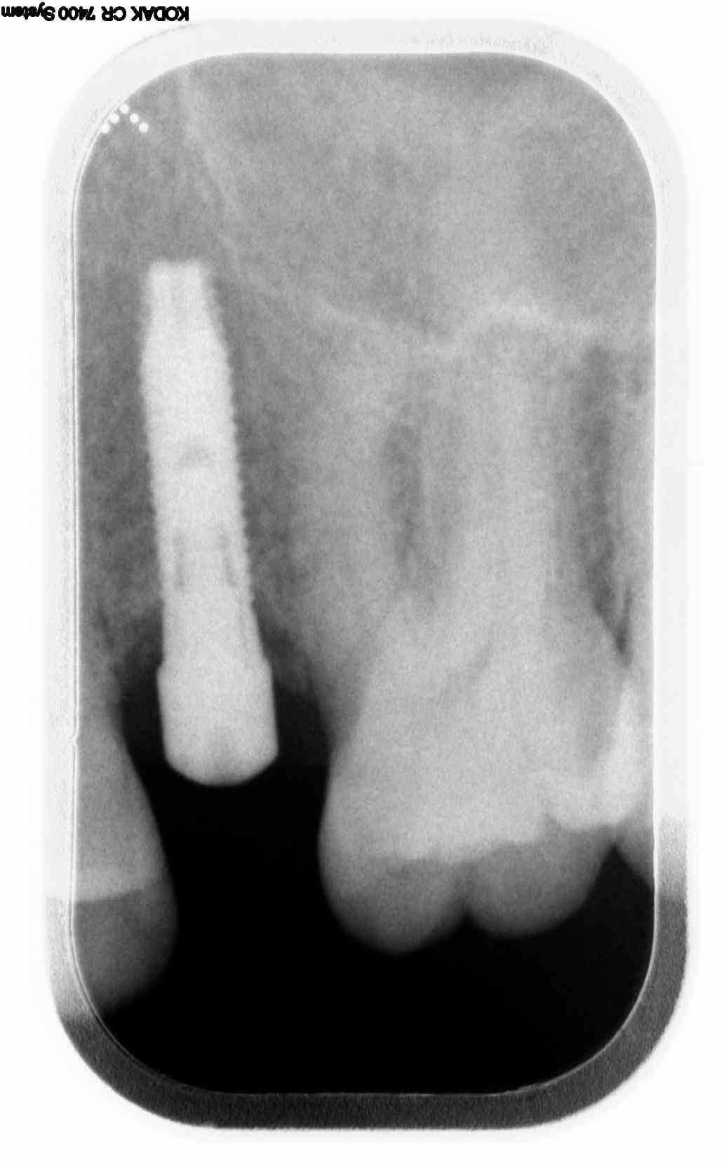 Un paio di anni fa ho inserito un impianto osseo per poi mettere il dente definitivo sostitutivo