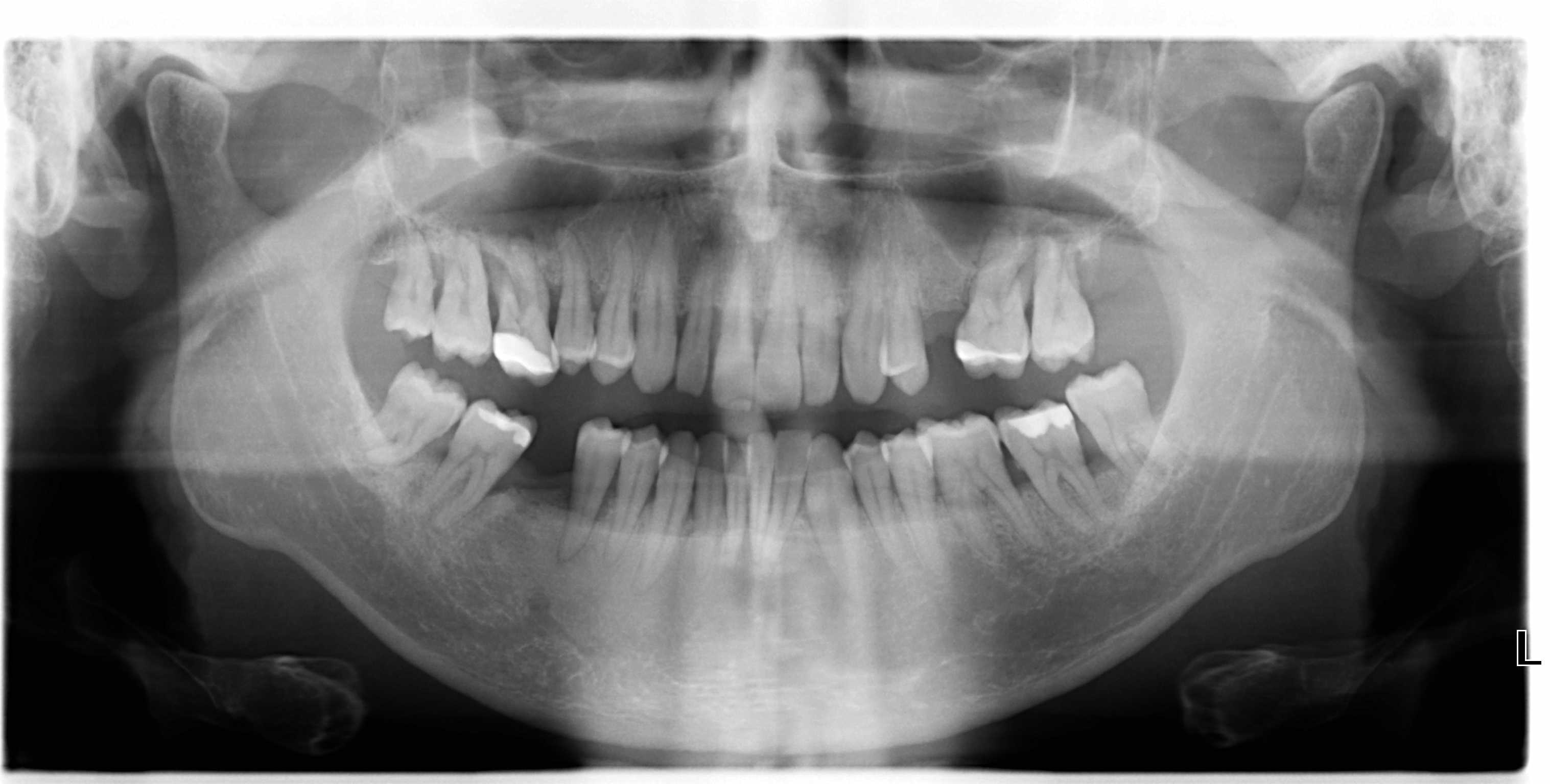 Nel mese di Giugno mi hanno diagnosticato la Parodontite