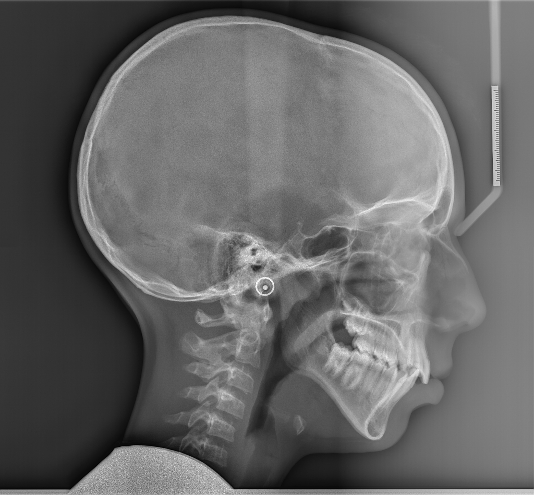 A mio figlio Ã¨ stata diagnosticata una II classe incisivo scheletrica e I prima classe dentale