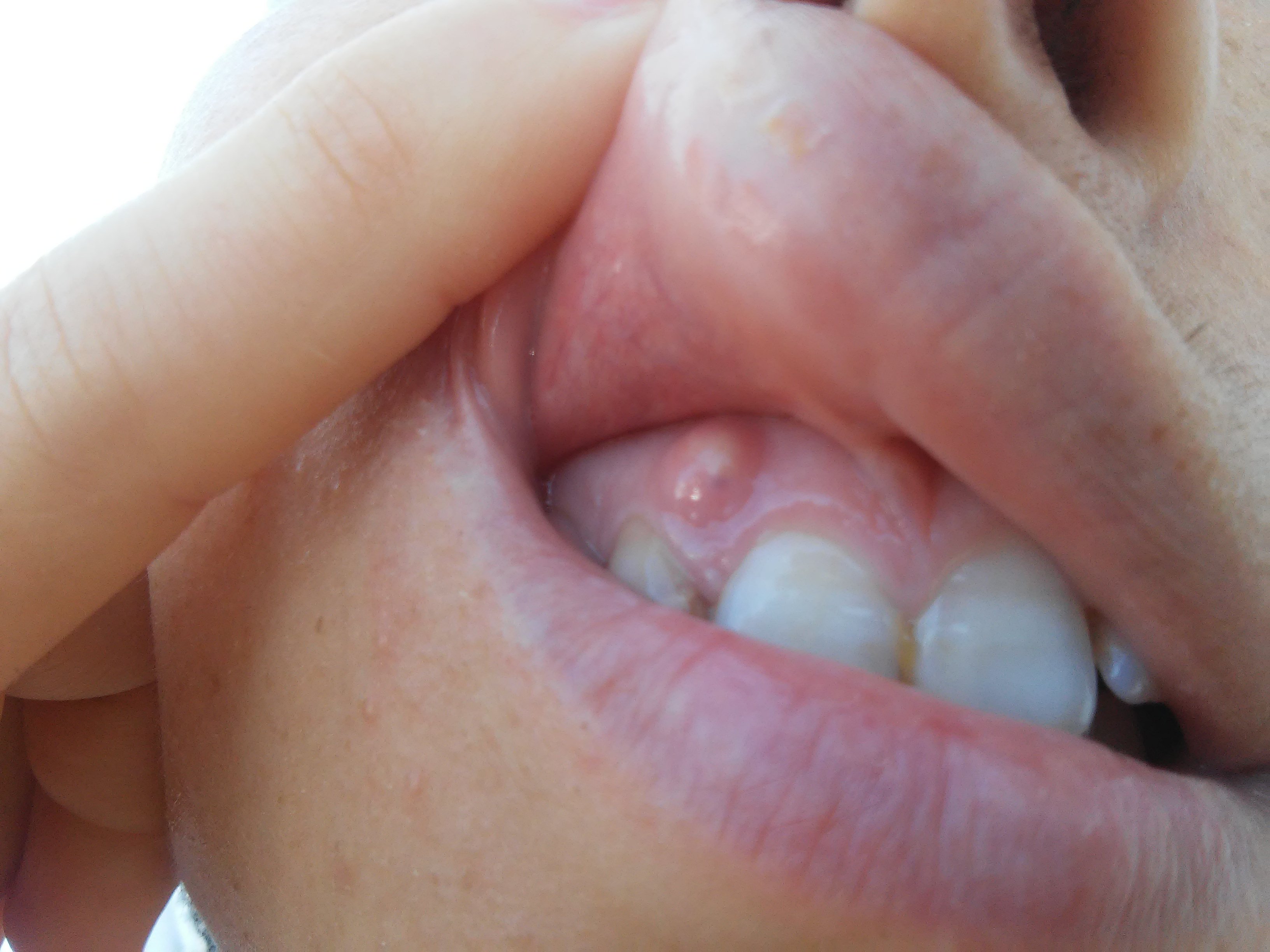 Rigonfiamento accanto ad un dente devitalizzato