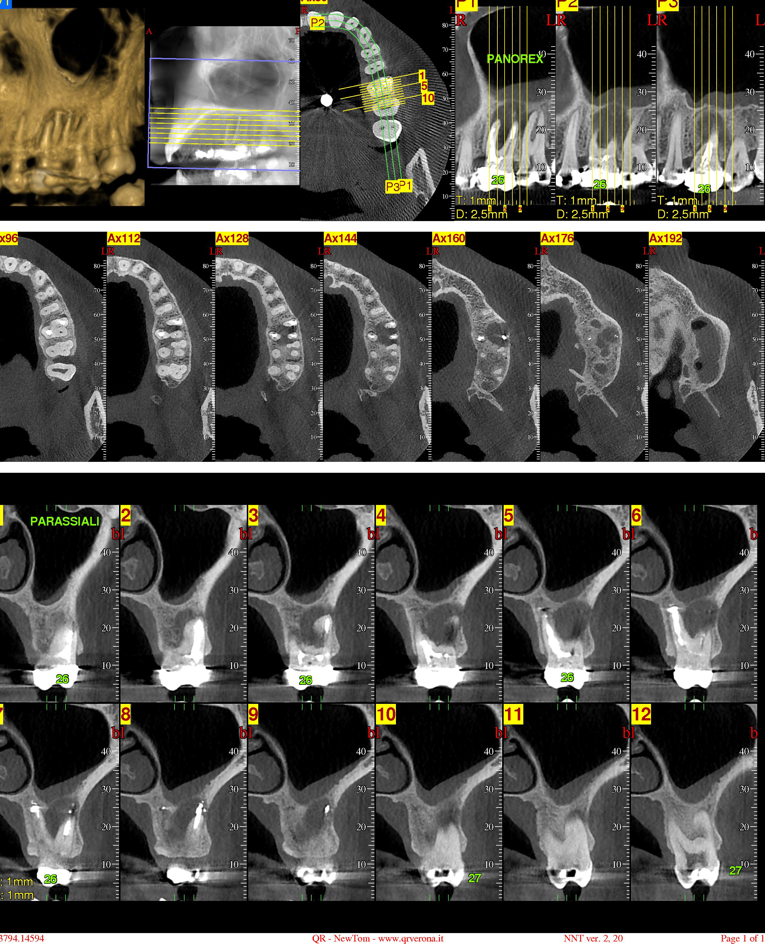 Ho effettuato una tomografia computerizzata del mascellare superiore di sx