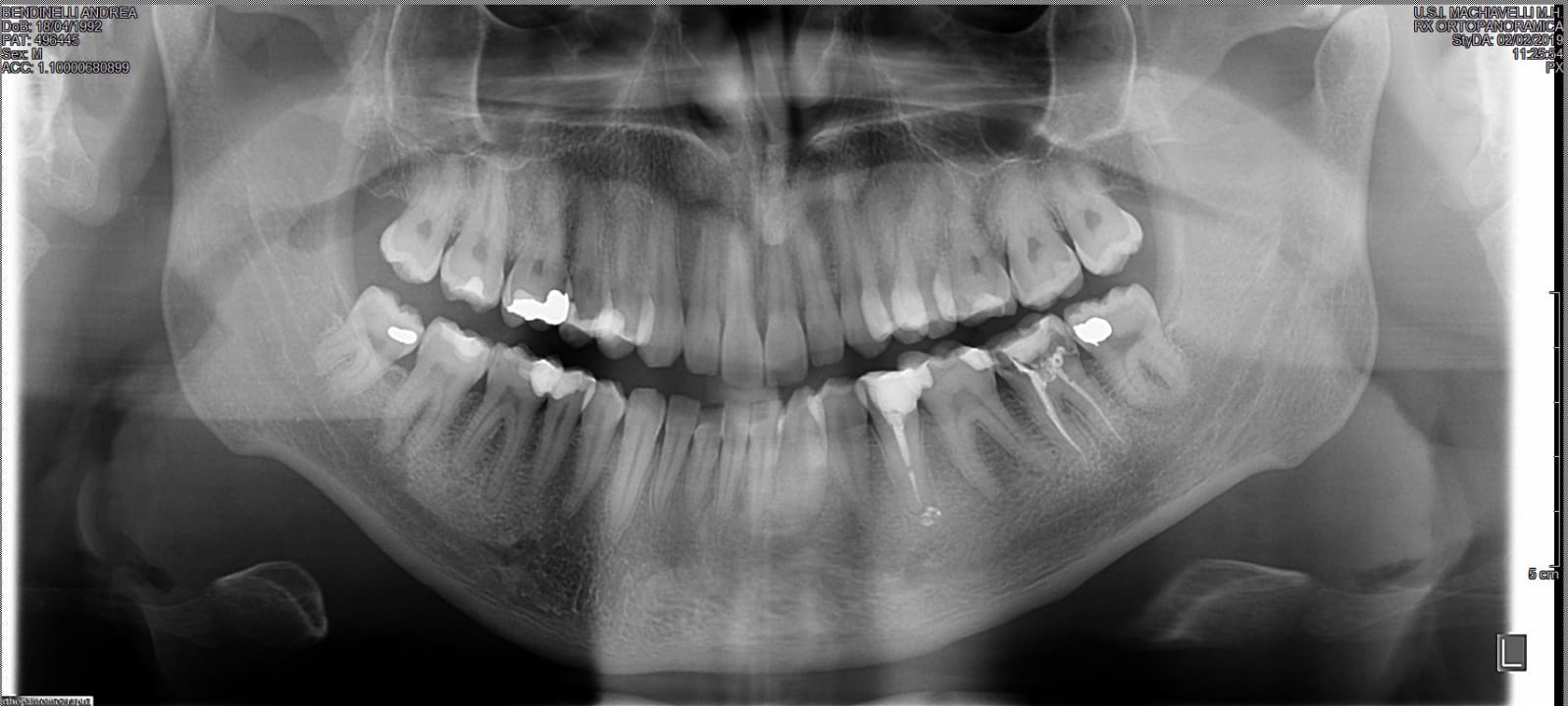 Meglio ritrattare i canali con l'inserimento di perni?