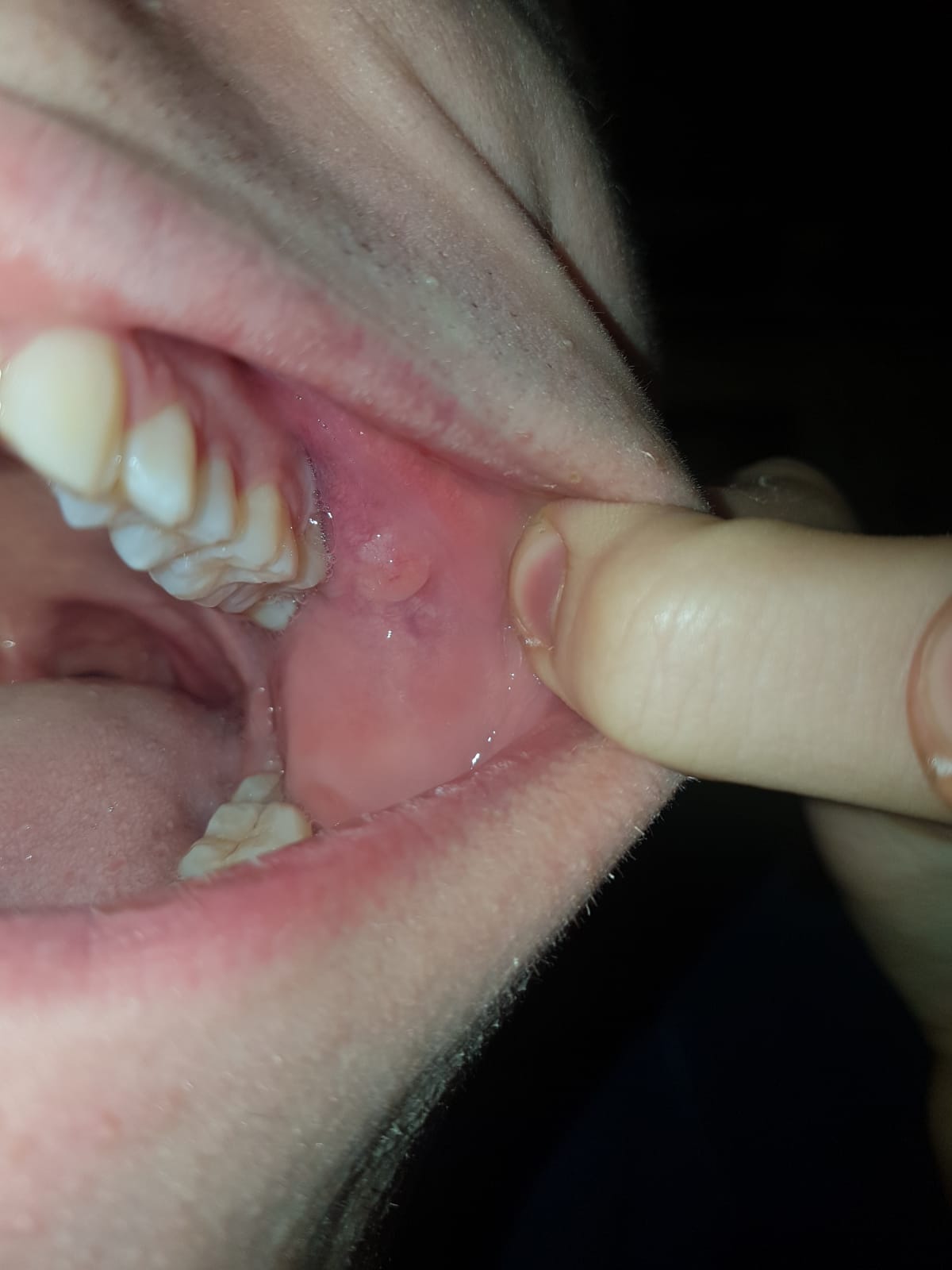 Da una settimana ho notato una strana escrescenza sulla parete interna della bocca