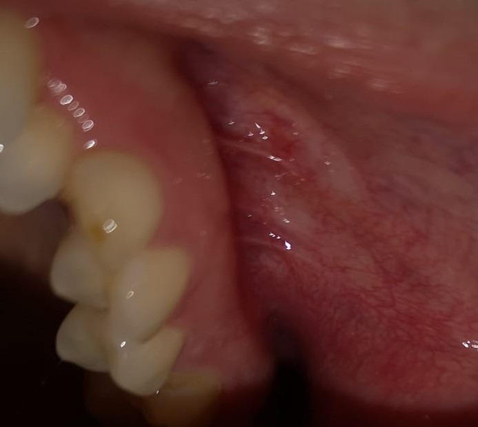 Può essere qualche infiammazione alla bocca o alle gengive?
