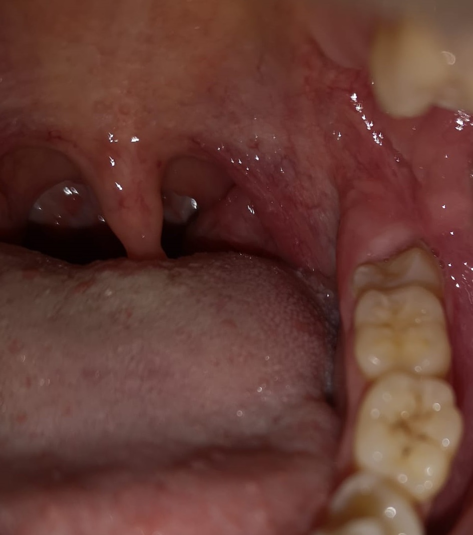 Può essere qualche infiammazione alla bocca o alle gengive?