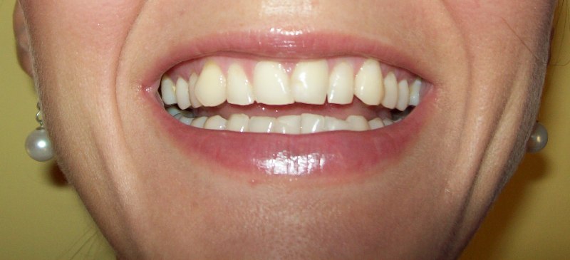 Affollamento dentale e Invisalign