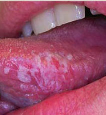 Lichen planus