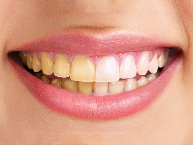 Salute dei denti, 5 nemici che la mettono a rischio