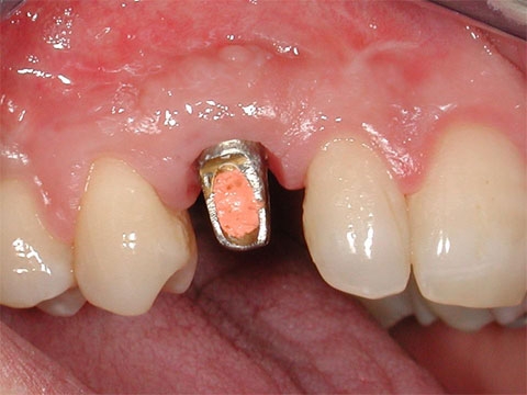 LE NUOVE FRONTIERE DELL'IMPLANTOLOGIA DENTALE