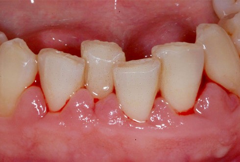 Carie e parodontite: i principali disturbi del cavo orale per l'Oms