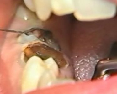 Allungamento clinico di 2 radici di molari inferiori destri (381)