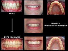 Invisalign