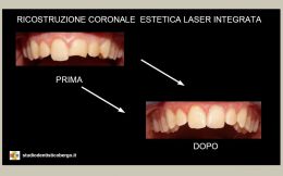Ricostruzione Coronale Estetica Laser Integrata (Laser Erbium-Yag)