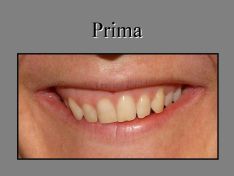 Laser in odontoiatria