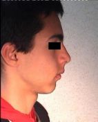 Trattamento ortodontico con tecnica Invisalign.
