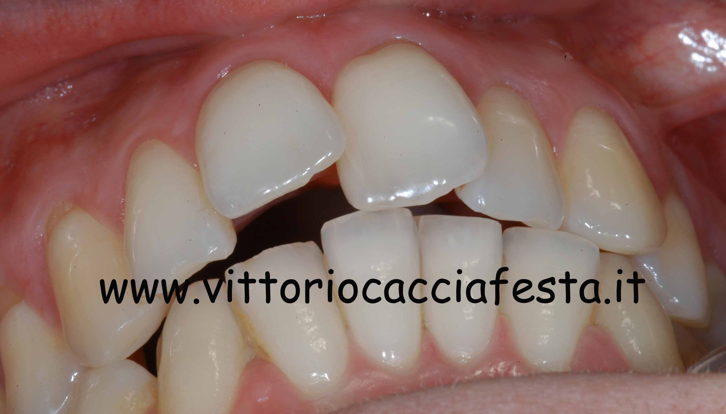 Trattamento di morso aperto e affollamento dentario in Ortodonzia Linguale