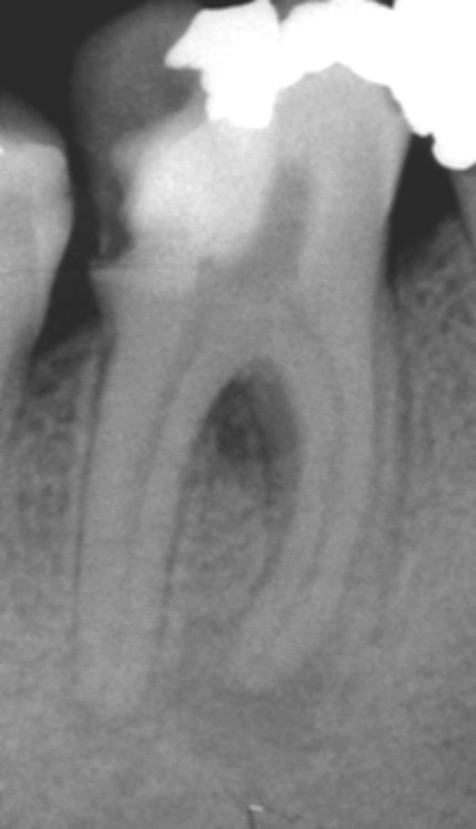 Granulomi che  guariscono con una corretta terapia endodontica