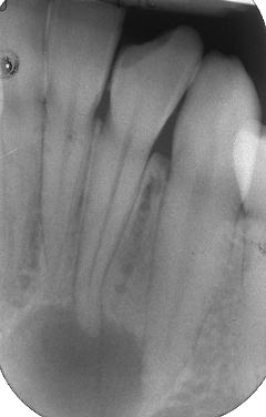 Cisti di origine endodontica