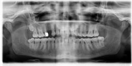 Impianto transmucoso