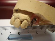Posizionamento, in mancanza di dimensione verticale, di impianto tipo thommen sull'arcata superiore.