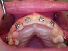 Estrusione chirurgica-ortodontica