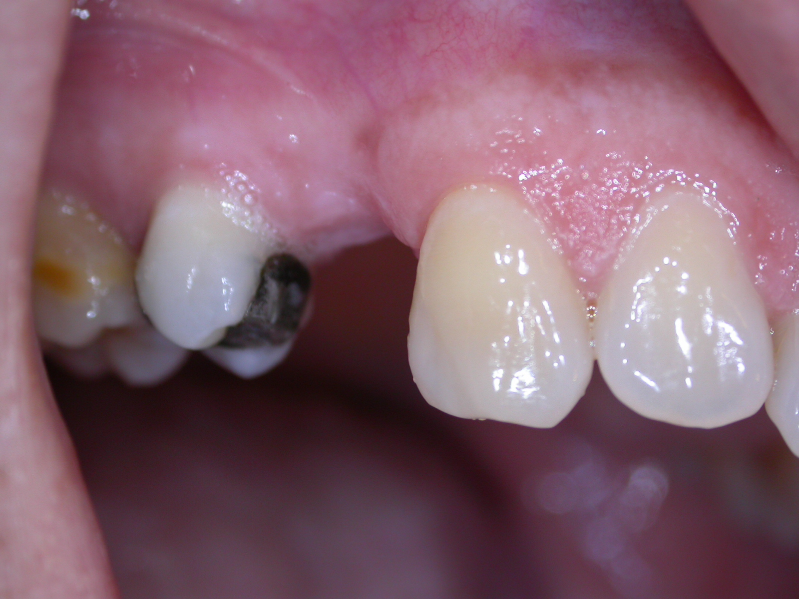 Sostituzione dente 1.5 con implantologia