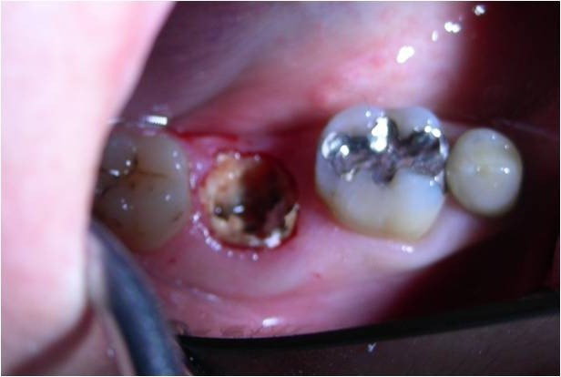Tecnica di inserimento impianto post-estrattivo immediato nel molare inferiore