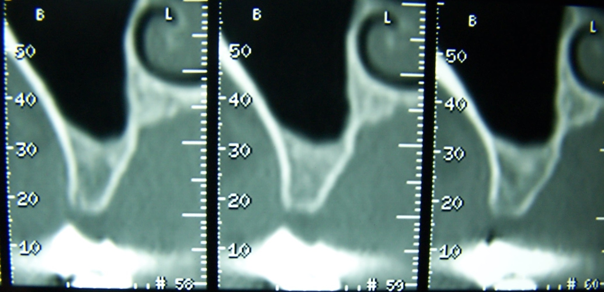 Piezosurgery: espansione orizzontale con mini-rialzo seno