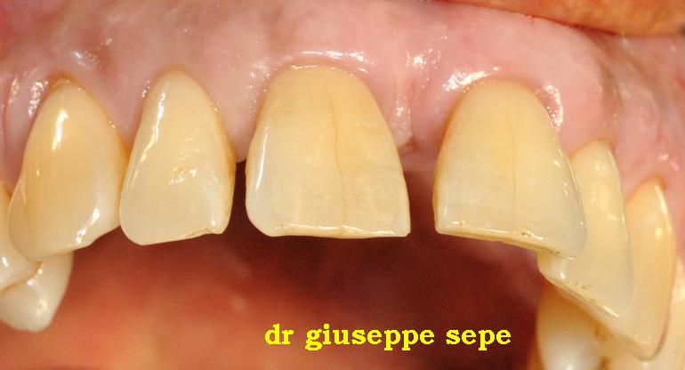 Piezosugery ed espansione controllata: impianti post estrattivi con carico immediato