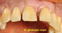Piezosugery ed espansione controllata: impianti post estrattivi con carico immediato