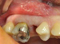Impianto post-estrattivo immediato con mectron piezosurgery