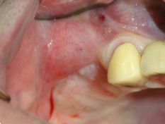 Grande rialzo seno mascellare con mectron piezosurgery