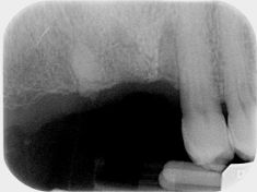 Piezosurgery: approccio crestale al seno mascellare