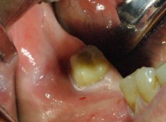 Piezosurgery: preparazione del sito implantare in 46
