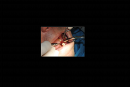 Implantologia tradizionale