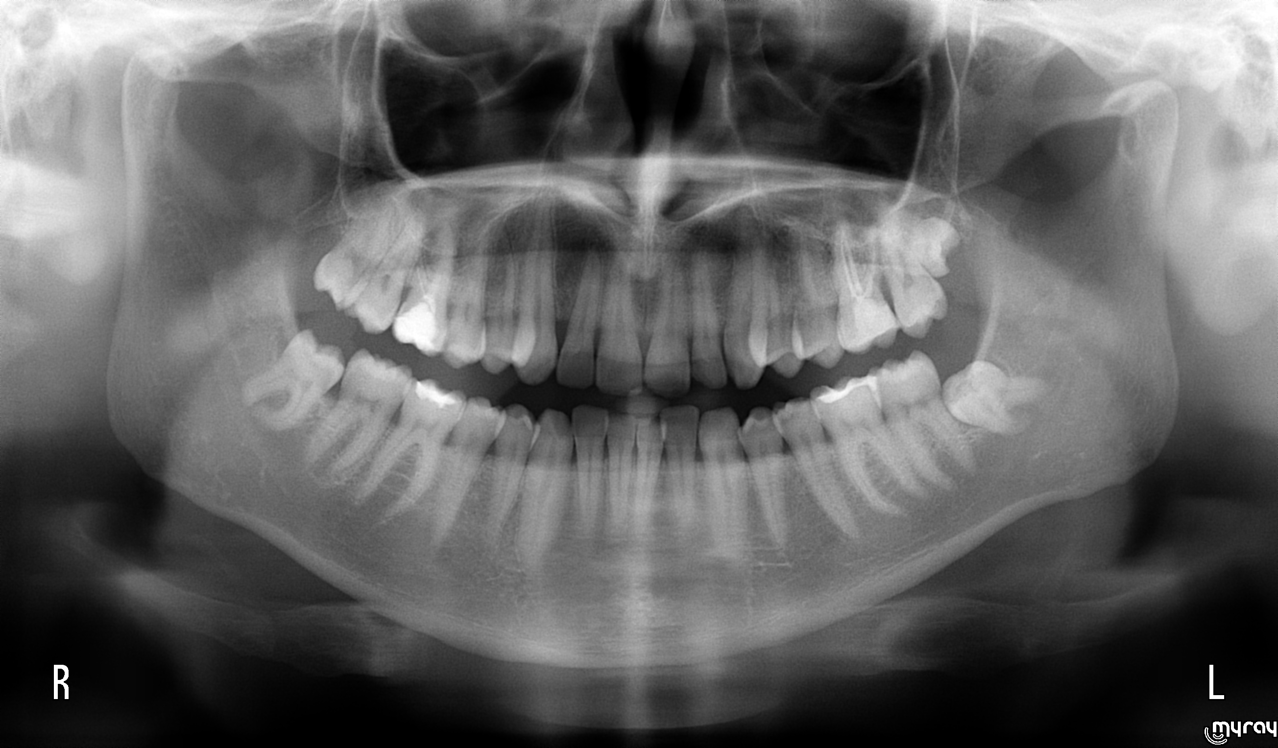 L'utilizzo della chirurgia piezoelettrica nell'avulsione dei denti del giudizio inclusi